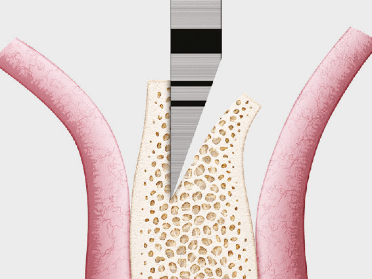 bone-expansion-ridge-split-kit.jpg