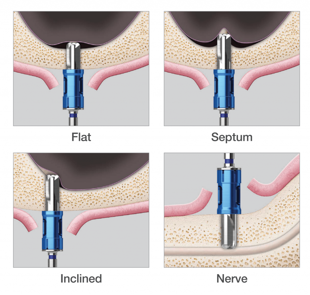 flat-septum-inclined-nerve.png