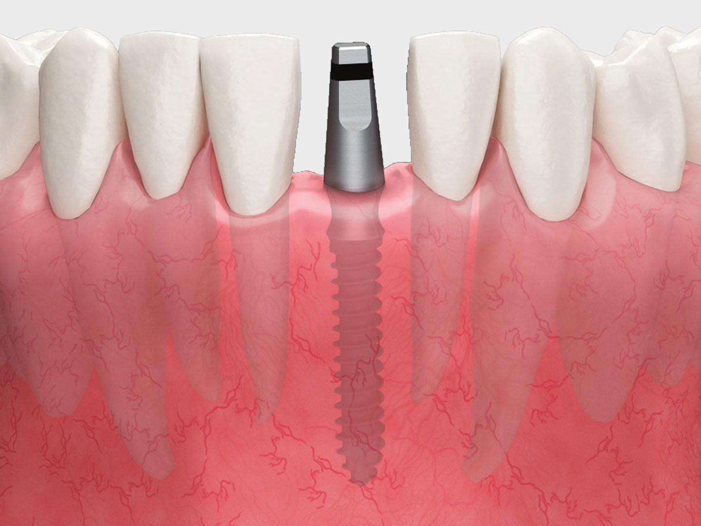 narrow-ridge-implant.jpg