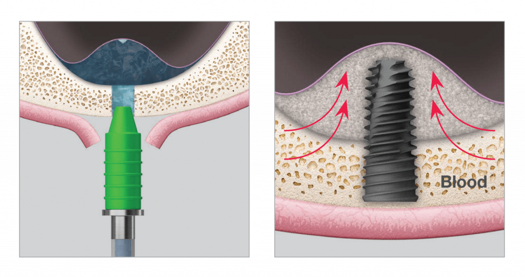 safe-elevation-sinus-membrane.png