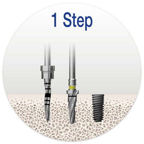 soft-bone-drilling-sequence.jpg