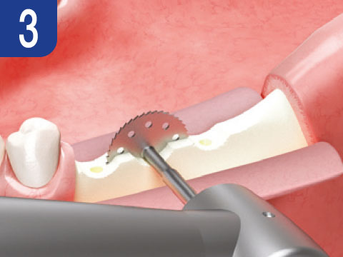 surgical-procedure-step-3-esset-kit.jpg