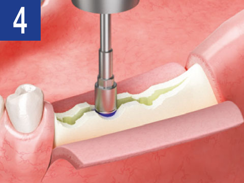 surgical-procedure-step-4-esset-kit.jpg