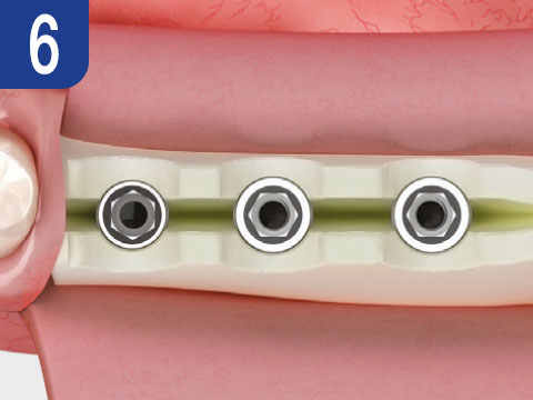 surgical-procedure-step-6-esset-kit.jpg