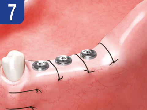 surgical-procedure-step-7-esset-kit.jpg