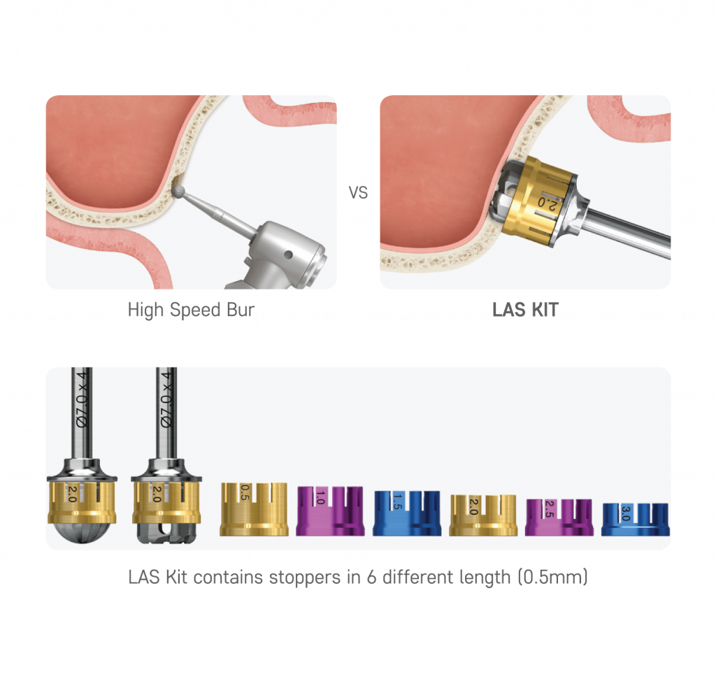 window-formation-lateral-sinus-surgery.png