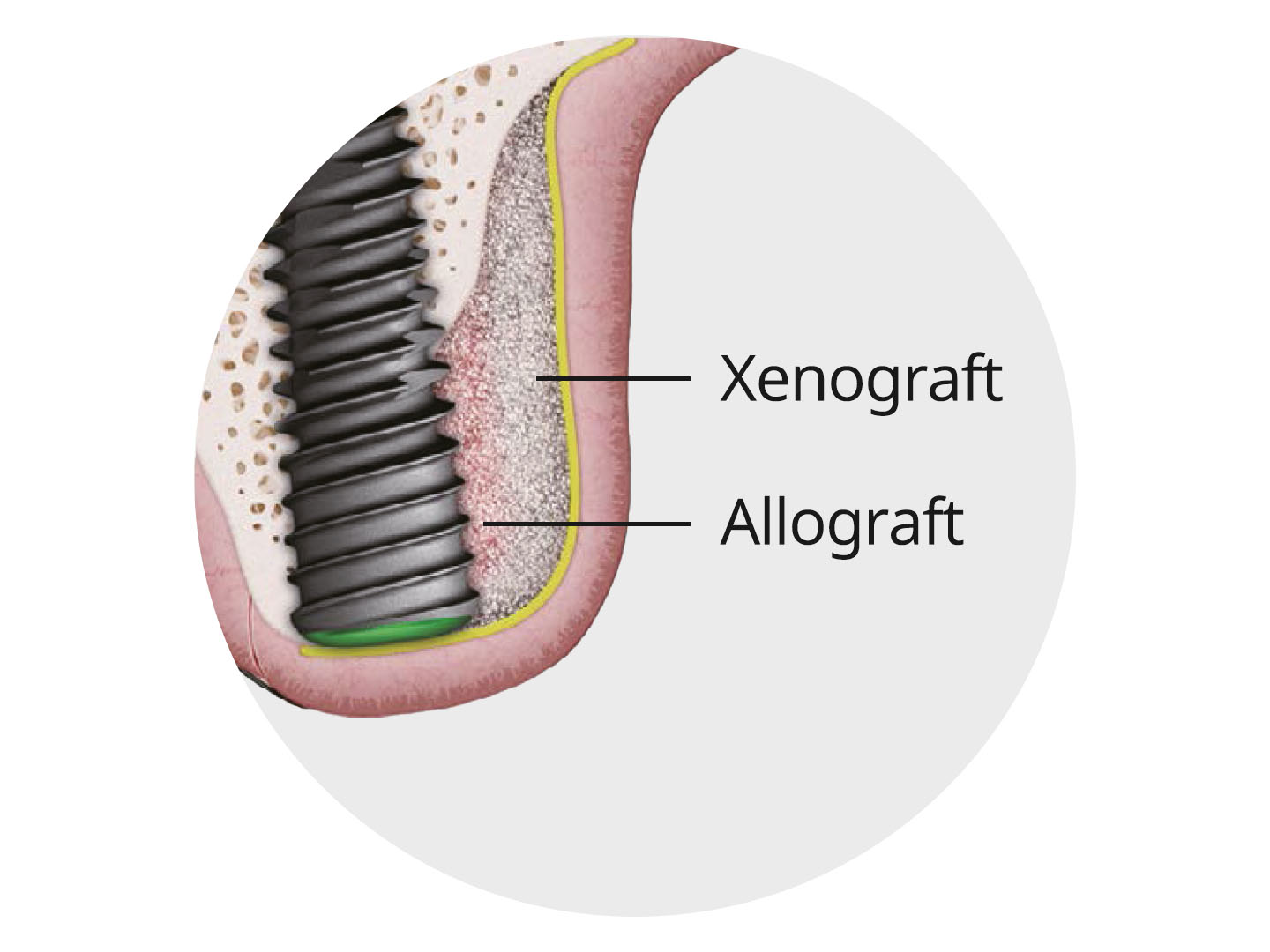 xenograft-allograft-a-oss.jpg